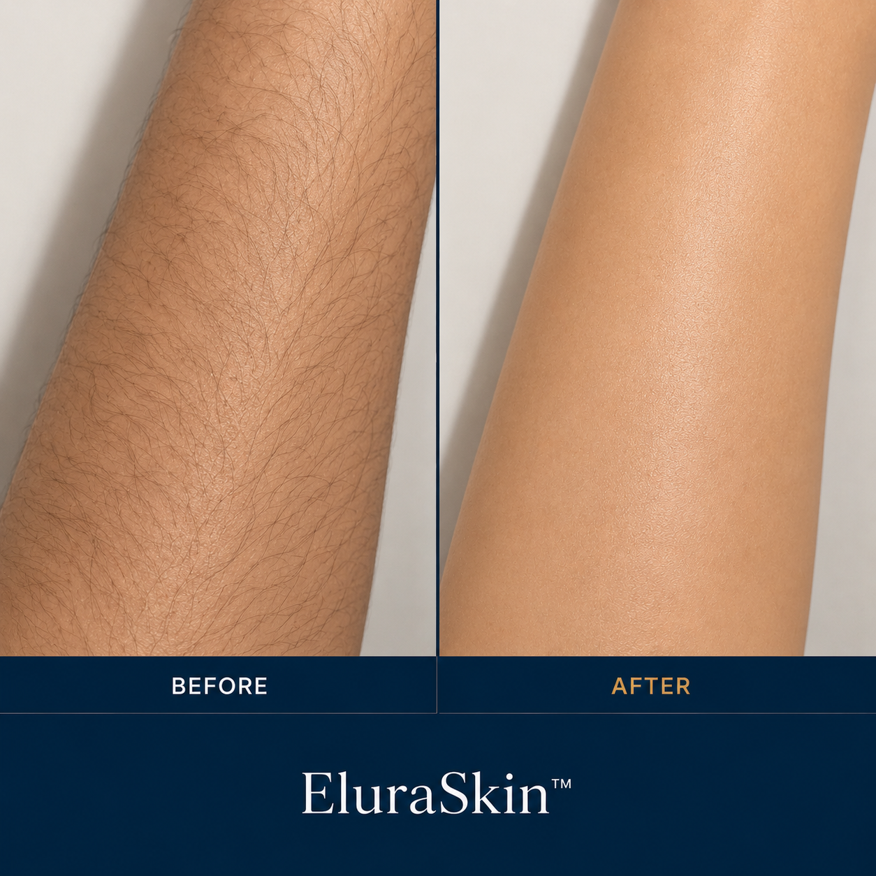 EluraSkin Precision IPL Device