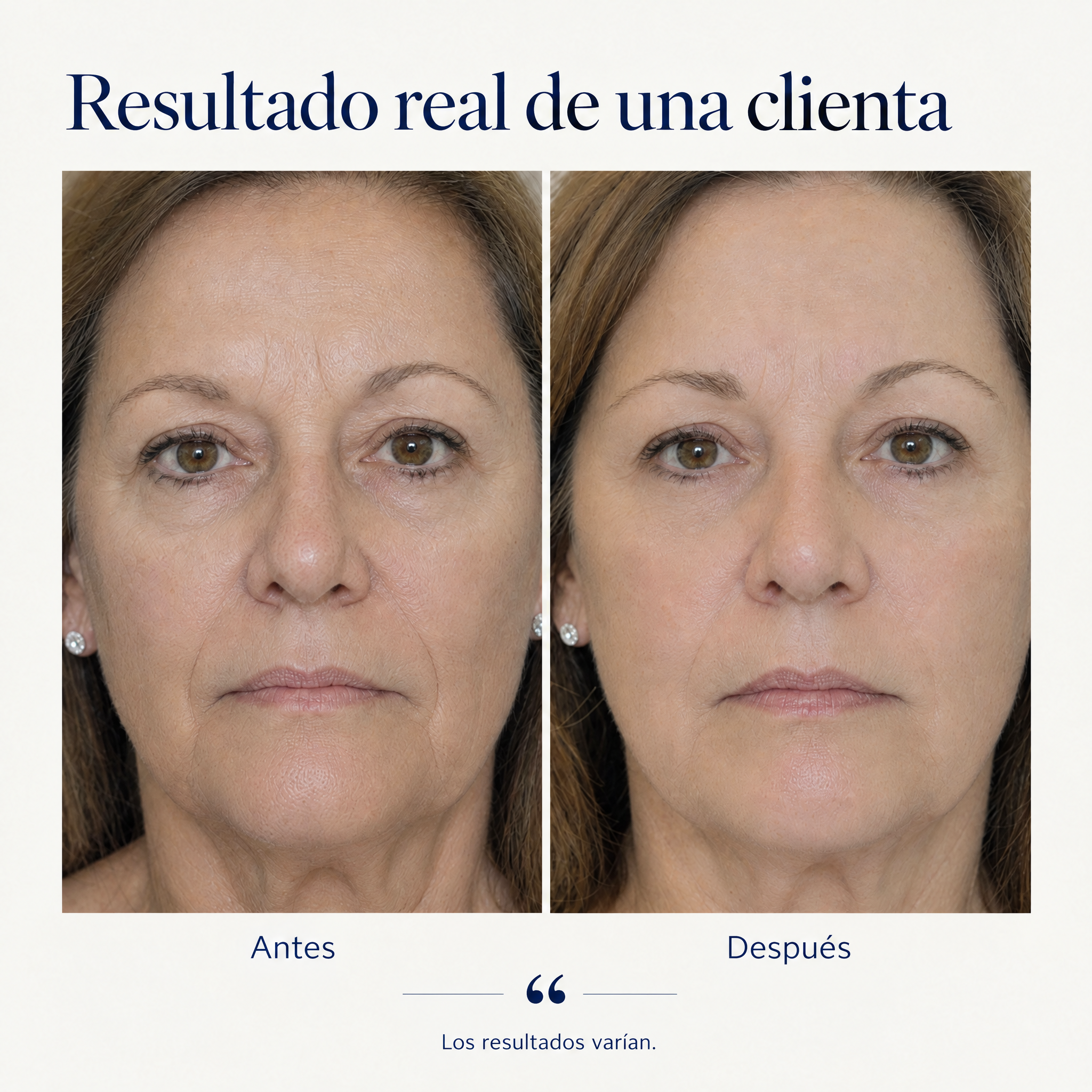 Before-and-after comparison of a woman's face showing skincare results, with the Spanish text 'Resultado real de una cliente', 'Antes', and 'Después' on a light beige background.